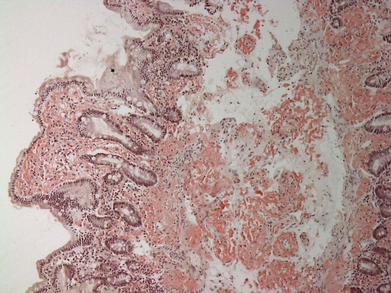 ملف:Small bowel duodenum with amyloid deposition congo red 10X.jpg