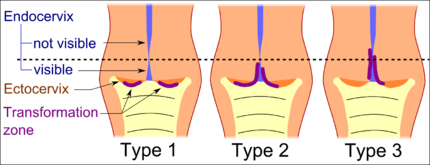 Transformation zone types:[22] Type 1: Completely ectocervical (common under hormonal influence). Type 2: Endocervical component but fully visible (common before puberty). Type 3: Endocervical component, not fully visible (common after menopause).
