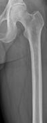 Same femur before myeloma lesions for comparison
