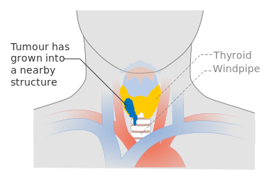 ملف:Diagram showing stage T4a thyroid cancer CRUK 272.svg