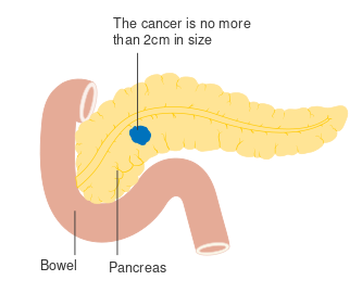 المرحلة T1 من سرطان البنكرياس.