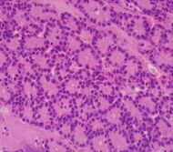 Histopathology of acinar cell carcinoma of the pancreas.jpg