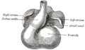 صورة تظهر القلب مع توسع الأذينين.