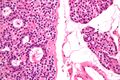 Parathyroid adenoma high mag.jpg