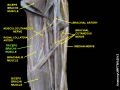 Triceps brachii muscle (shown in green text)