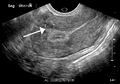 A small uterine fibroid seen within the wall of the myometrium on a cross-sectional ultrasound view
