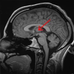 Brain chrischan thalamus.jpg