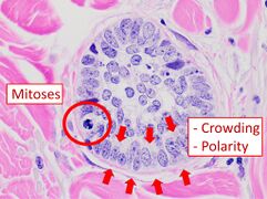 Cellular arrangement, including crowding and cell polarity (common tendencies among cells at the border, such as elongation or "palisading" in this case). Amount of mitoses can also be appreciated at this level.