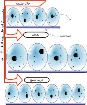 Hyperplasia vs Hypertrophy(Ara).png