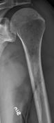 Humerus with multiple myeloma lesions.