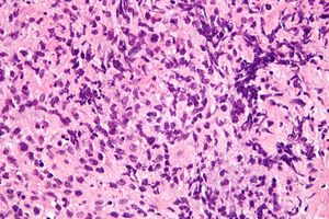 Primary mediastinal large B-cell lymphoma - very high mag.jpg