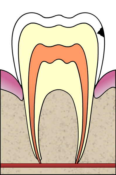 ملف:Cavities evolution 2 of 5 ArtLibre jnl.png