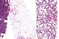 Micrograph of a dedifferentiated liposarcoma, H&E stain