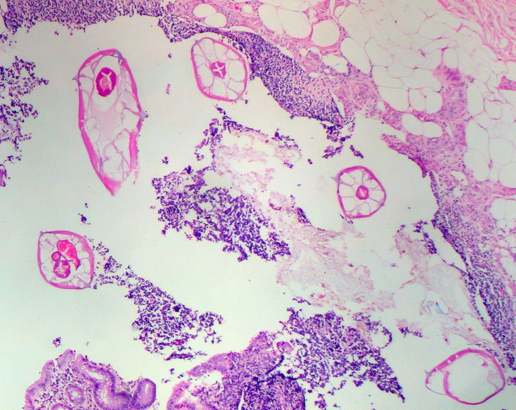 ملف:Pinworms in the Appendix (1).jpg