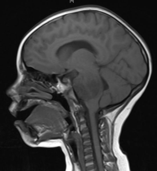 ملف:Tumor BrainstemGlioma2.JPG