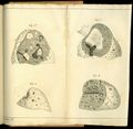 De l’auscultation médiate... Most of the plates in his book illustrate the diseased lung as do these four images that are consistent with lungs affected by tuberculosis.