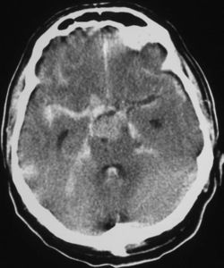 Subarachnoid hemorrhage CT.JPG