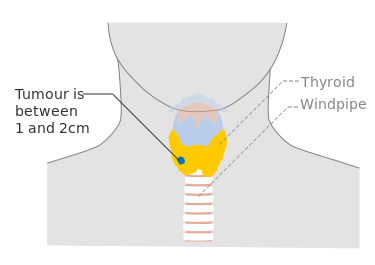 ملف:Diagram showing stage T1b thyroid cancer CRUK 251.svg