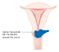 المرحلة 2B من سرطان عنق الرحم.