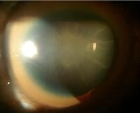 ساد العين في شكل عباد الشمس وحلقة KF السميكة لرجل يبلغ من العمر 40 عامًا مصابًا بداء ويلسون و مرض كبدي مزمن غير معوض