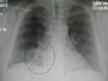 AP CXR showing right lower lobe pneumonia
