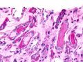 Micrograph showing myeloma cast nephropathy in a kidney biopsy. Hyaline casts are PAS positive (dark pink/red - right of image). Myelomatous casts are PAS negative (pale pink - left of image). PAS stain.