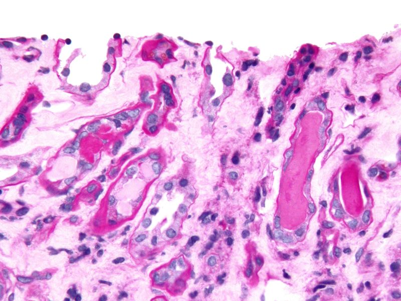 ملف:Cast nephropathy - 2 cropped - very high mag.jpg
